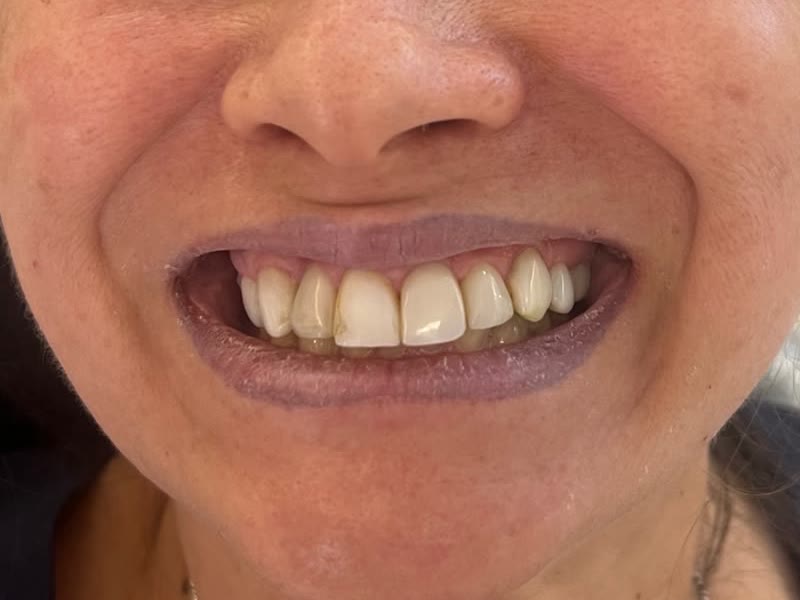 Antes: dentes desalinhados e com manchas