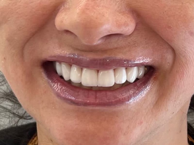 Depois: sorriso com lentes, dentes claros e alinhados